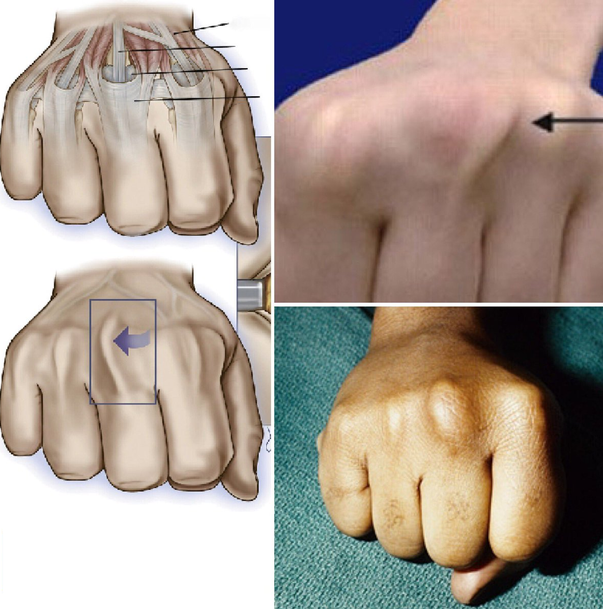 Khớp tay bị ảnh hưởng do thường xuyên sử dụng găng tay chật.