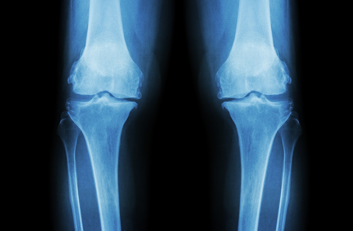 Chụp x-quang mô sụn giúp nhận định bạn có phát triển chiều cao nữa không