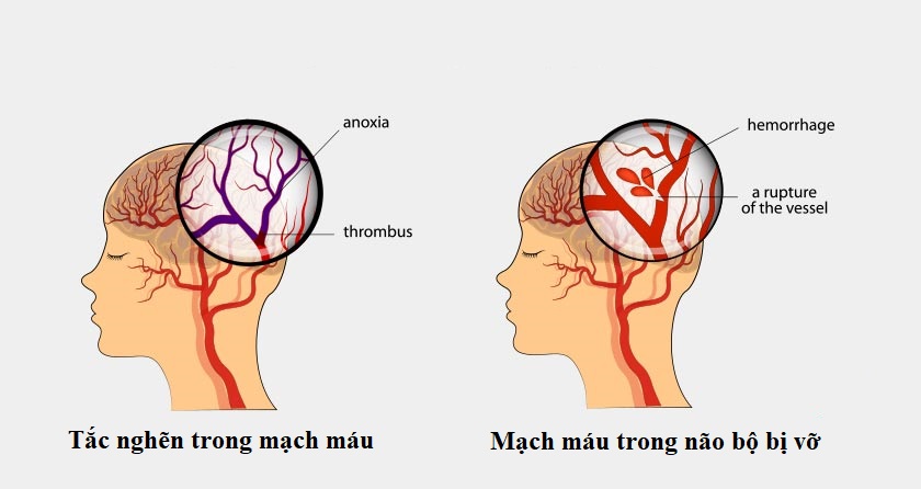 Nguyên nhân gây tai biên mạch máu não